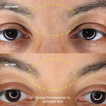 Dermaplaner, Gold